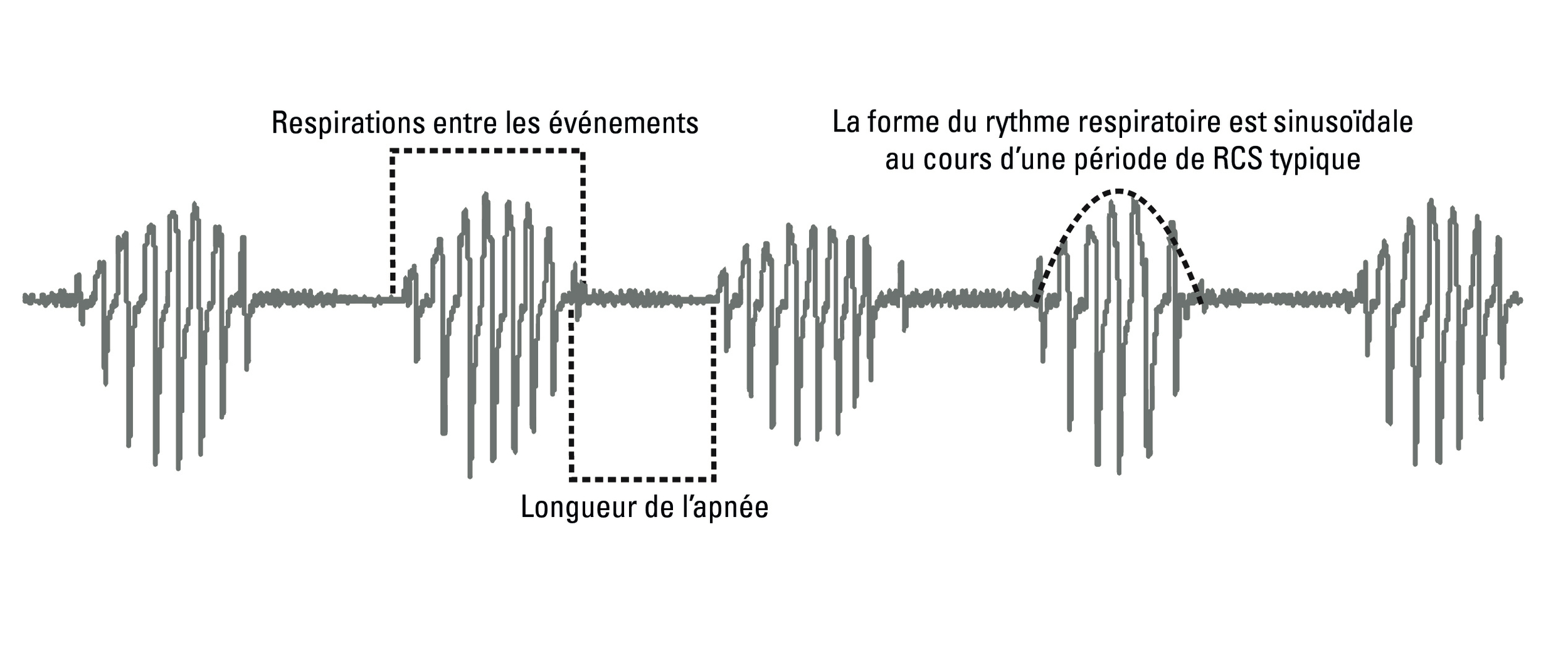 SL Diagram Cheyne-Stokes respiration detection