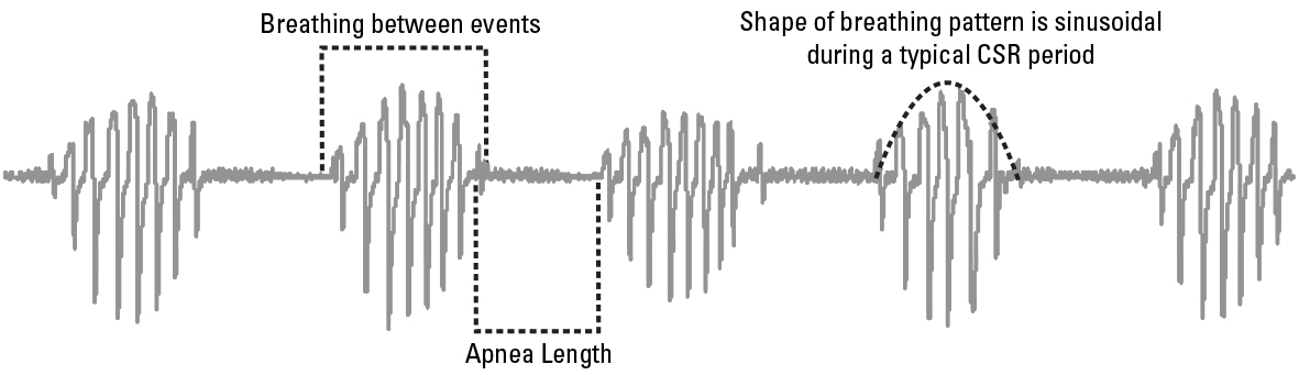 SL Diagram Cheyne-Stokes respiration detection