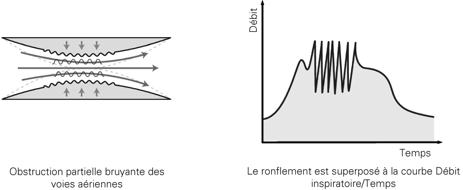 SL Diagram Snore