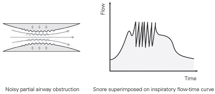 SL Diagram Snore