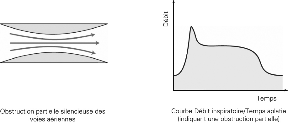 SL Diagram Flow limitation