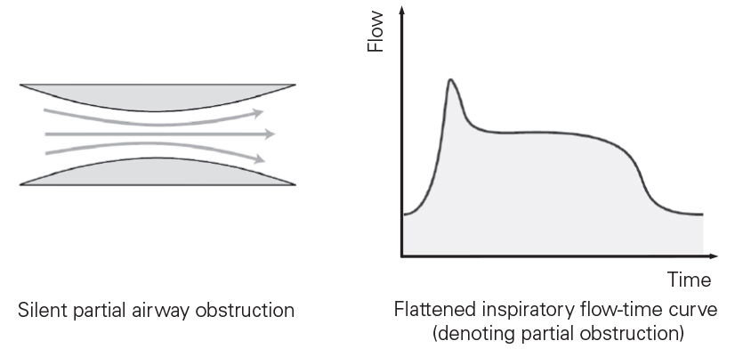 SL Diagram Flow limitation