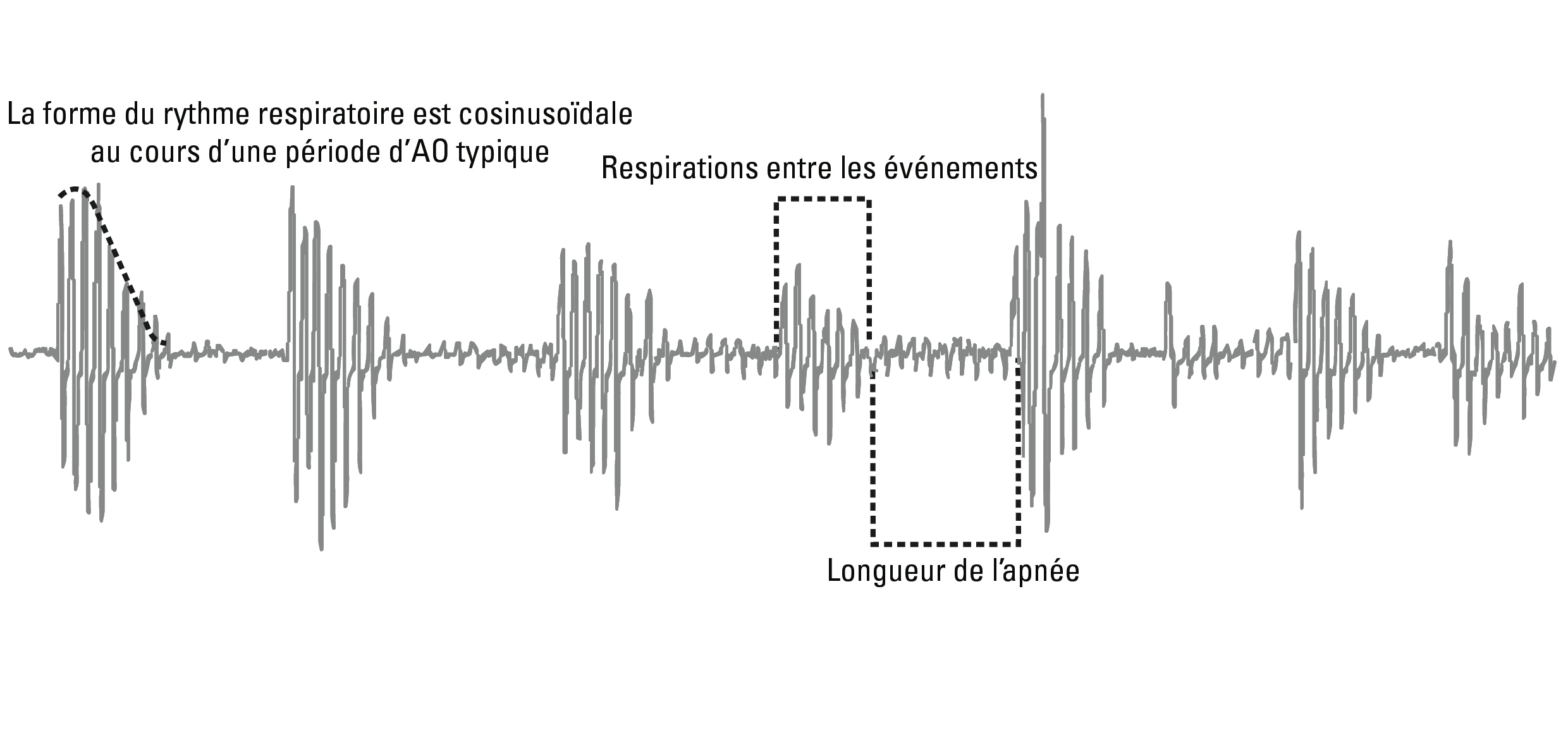 SL Diagram Cheyne-Stokes respiration detection 2