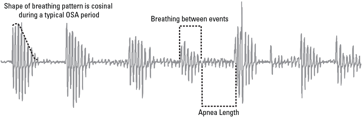 SL Diagram Cheyne-Stokes respiration detection 2